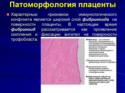 Фибриноид