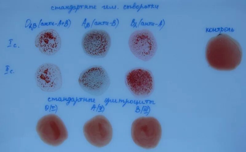 Как отличить кровь. Перекрестная методика определения группы крови. Перекрестный метод определения группы крови. Группа крови перекрестный метод. Перекрестное определение группы крови.