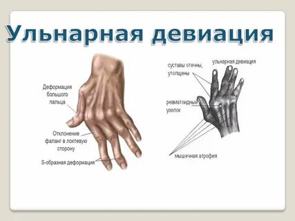 Ревматоидный артрит кисти