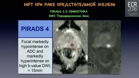 Что покажет мрт предстательной железы