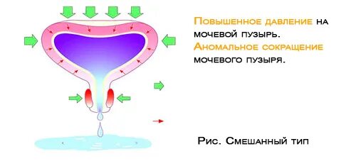 Недержание мочи. Смешанное недержание мочи. Недержание мочи иллюстрация. Патогенез недержания мочи. Операция стрессовое недержание мочи