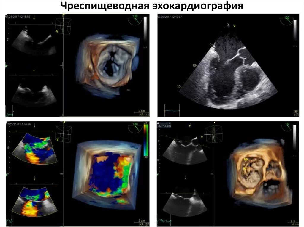 Эхо кардиография. Чреспищеводная эхокардиография сердца. Чреспищеводная эхокардиография митральный клапан. Трансторакальная трехмерная эхокардиография. . Чреспищеводная Эхо-кг (ЧПЭХО)..