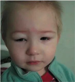 Опухшее лицо у ребенка