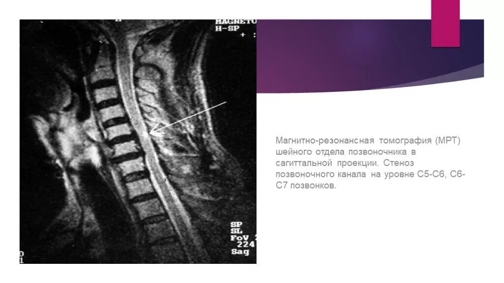 Поясничный абсолютный стеноз. Стеноз шейного отдела позвоночника мрт. Сагиттальный стеноз позвоночного канала с5-с7. Позвоночный канал мрт стеноз. Стеноз позвоночного канала мрт.