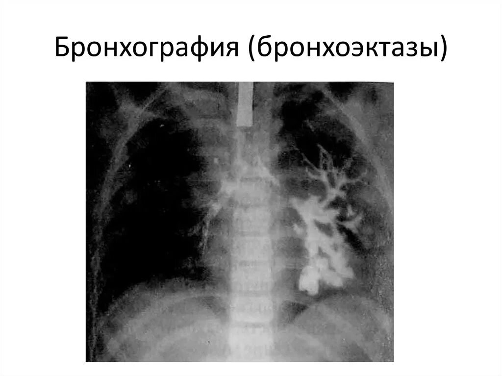 Врожденный туберкулез. Бронхоэктатическая болезнь бронхография. Мешотчатые бронхоэктазы на бронхографии. Бронхография пневмония. Бронхоэктатическая пневмония.