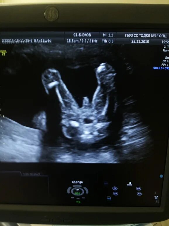 Узи скрининг 2 триместра мальчик. Второе скрининговое узи. Второй скрининг узи 20 недель. Узи 2 скрининг мальчик при беременности. 2 скрининг девочки.