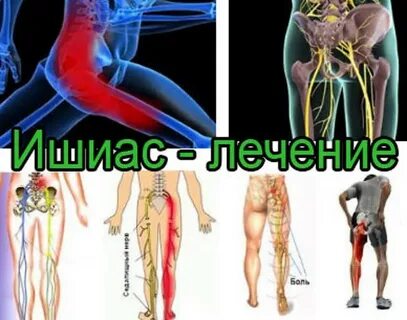 Последствия ишиаса седалищного нерва