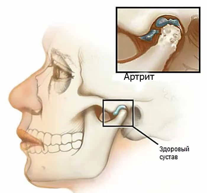 Из за чего может болеть челюсть. Артроз височно-нижнечелюстного сустава. Острый артрит височно-нижнечелюстного сустава.