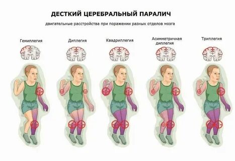 Операции при дцп