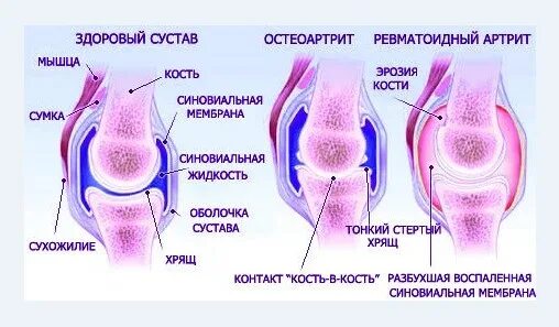 Ревматоидный артрит мышцы