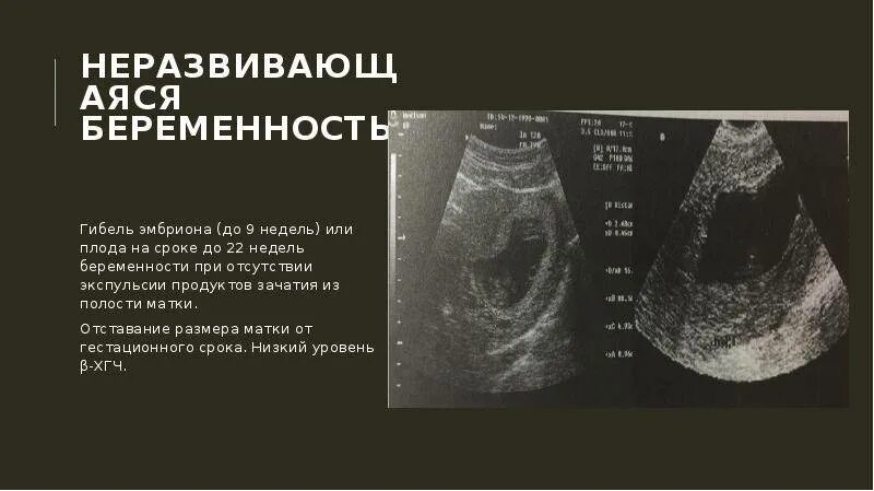 Замершая беременность во 2 триместре. УЗИ признаки неразвивающейся беременности. Симптомы при замершей беременности 9 недель беременности. Замершая беременность 6-7 недель причины. Неразвивающаяся беременность причины.