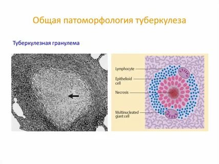 Гранулема туберкулеза