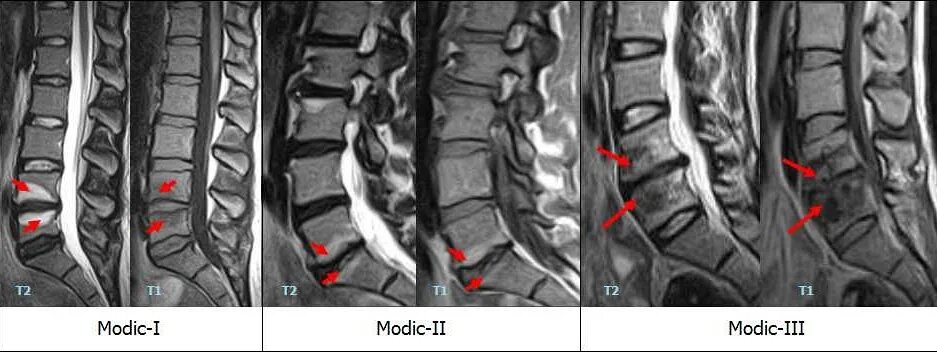 L5 s1 Modic 1. Асептический спондилодисцит l5-s1. Modic 2 на мрт. Субхондральный остеосклероз мрт. Участки отека костного мозга