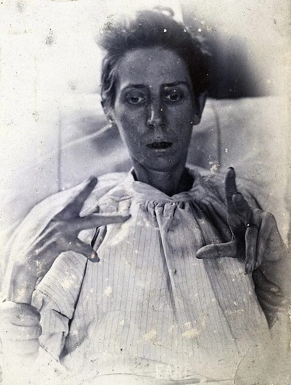 Фотографии людей больных шизофренией. Больные шизофренией фото. Люди с психическими заболеваниями. Человек больной шизофренией. Больные шизофренией фото.