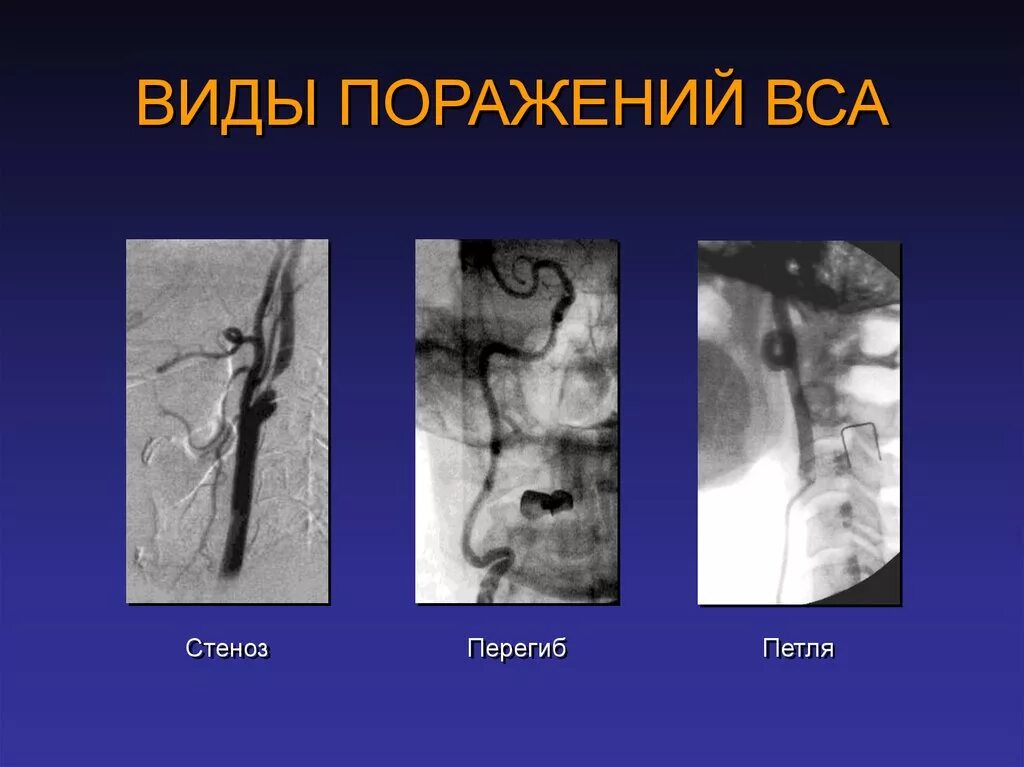 Изгиб вса. S-образная извитость внутренней сонной артерии. Петля внутренней сонной артерии.