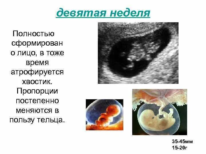 9 недель признаки. Плод в 9 недель и 3 дня беременности. 8-9 Недель беременности размер плода. Размер плода на 9 неделе беременности акушерской. Размер ребенка на 9 неделе беременности.