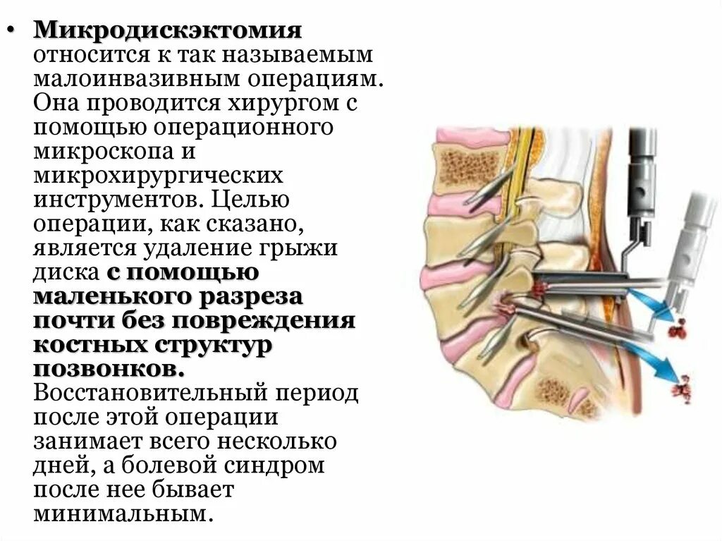 Удаление грыжи в пояснице. Микродискэктомия грыжи позвоночника. Эндоскопическая дискэктомия грыжи позвоночника. Операция межпозвоночной грыжи микродискэктомия. Микродискэктомия поясничного отдела позвоночника l5-s1.