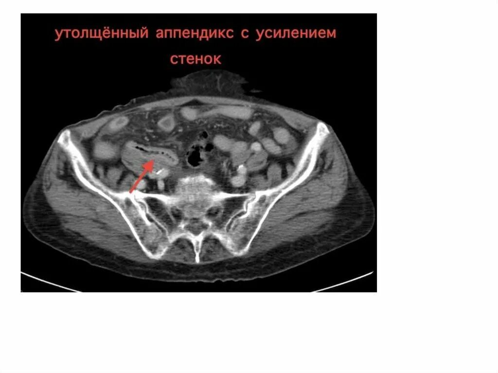 Малом тазу аппендицит