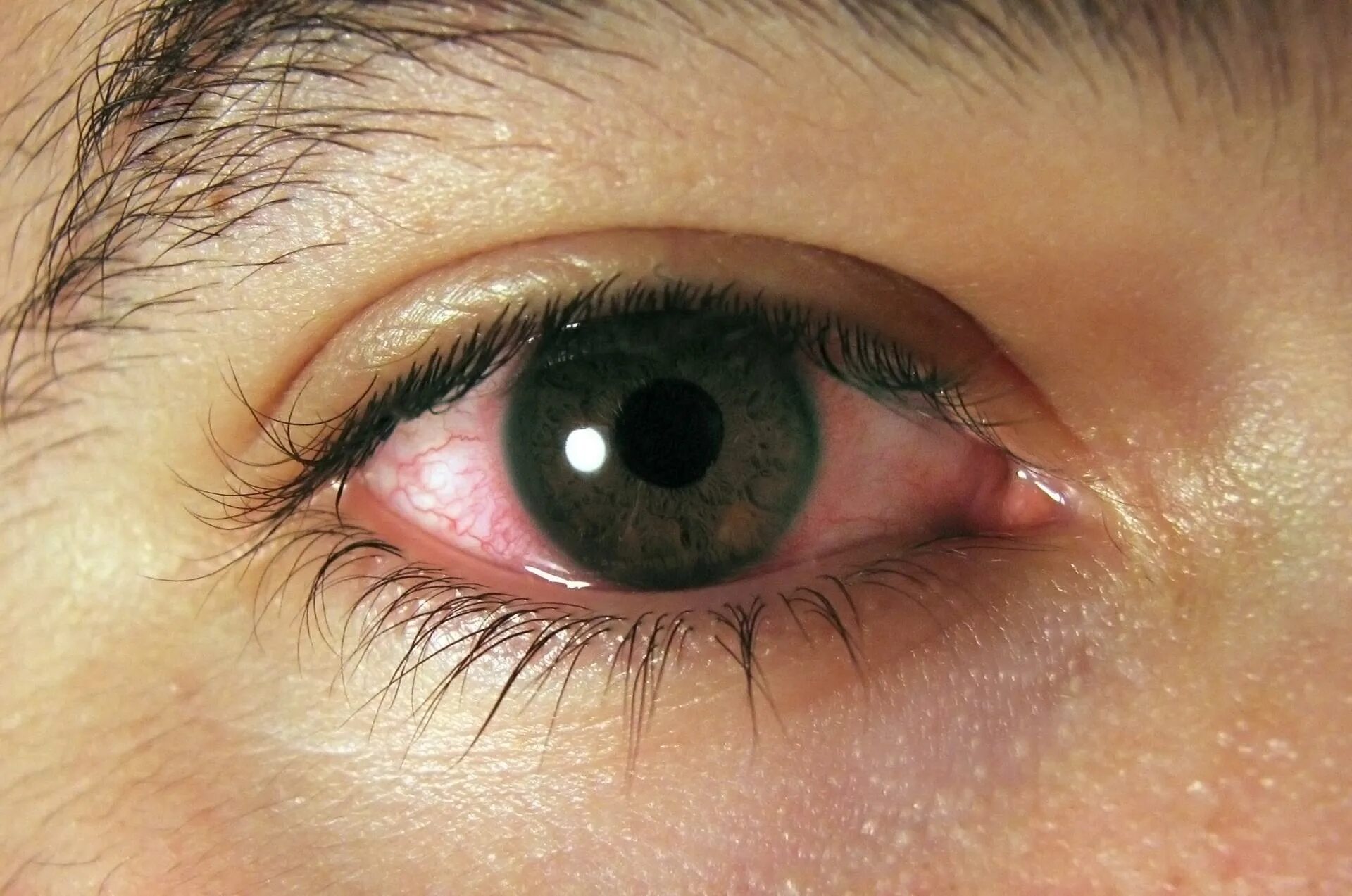 Болит глаз месяц. Кератит, конъюнктивит, увеит). Хламидийный конъюнктивит-кератит.