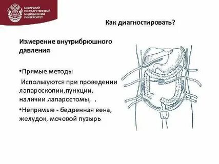 Мочевой пузырь брюшная полость