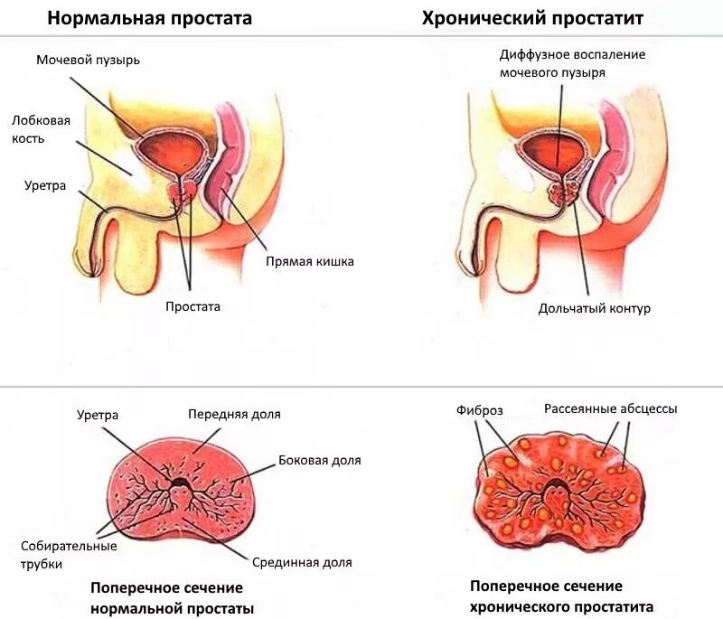 Воспалился простатит. Простатит предстательной железы. Воспаление предстательной железы. Хроническое воспаление предстательной железы. Хронический простатит.