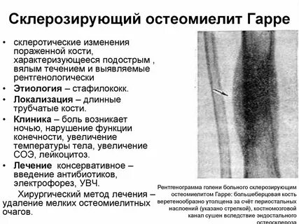 Острый остеомиелит признаки