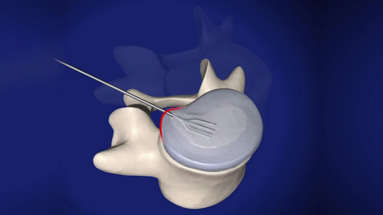 Нуклеопластика межпозвонкового диска. Пункционная нуклеопластика. Холодноплазменная нуклеопластика. Нуклеопластика грыжи позвоночника. Позвоночник операция лазером