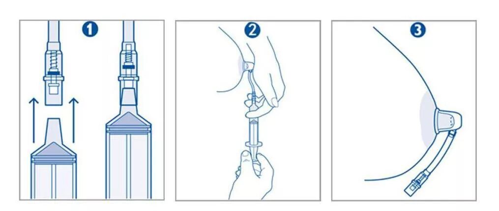 Шприц для вытягивания сосков. Шприц для втянутых сосков. Плоский и втянутый сосок. Вытянуть плоский сосок.