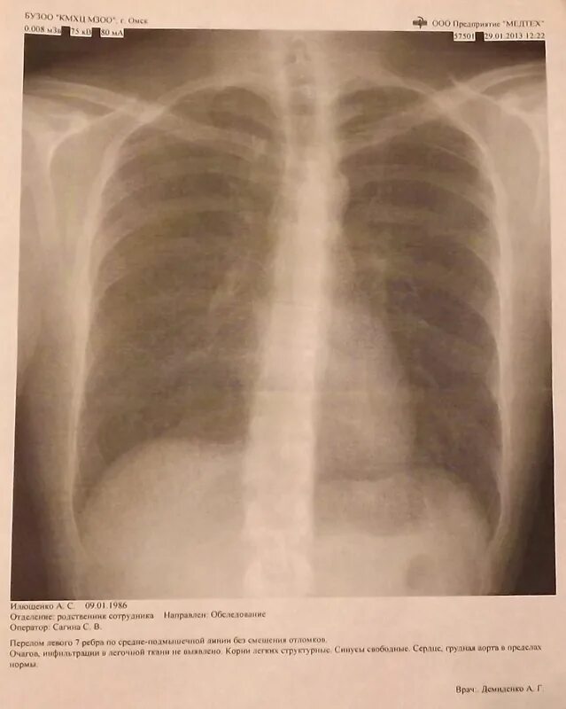 Перелом ребер рентген описание. Поднадкостничный перелом ребра. Перелом ребер рентгенограмма. Перелом реберного хряща рентген. Окончатый перелом ребер.