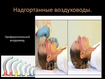 Надгортанный воздуховод