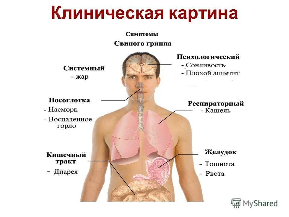 Симптомы гриппа. Свиной грипп. Симптомы гриппа свиной грипп. Клиническая картина ОРВИ.