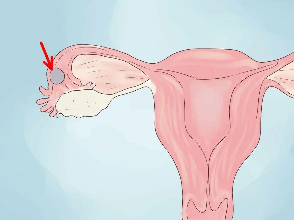 Оплодотворение в полости матки. Внематочная беременность в маточной трубе. Фаллопиевы трубы у женщин. Внематочная беременность рисунок. Непроходимость маточных труб.