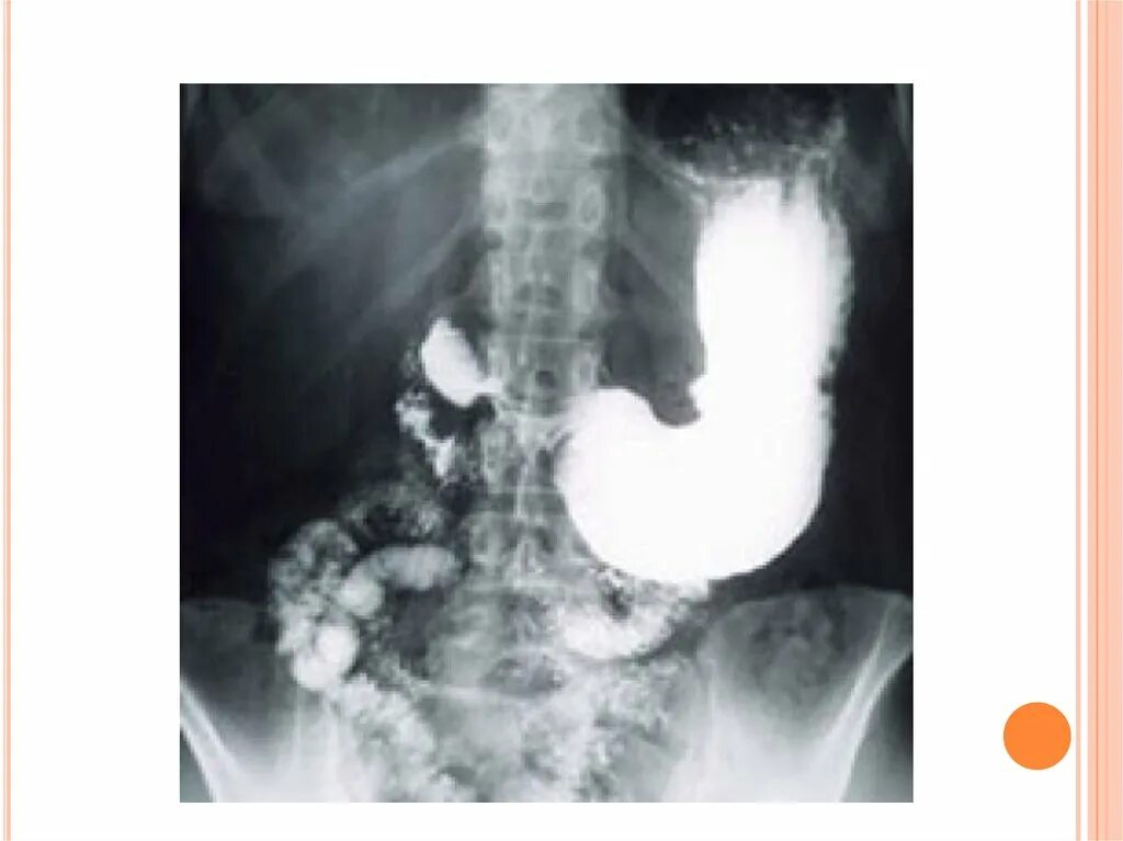 Рентген желудка и 12-перстной кишки. Рентген двенадцатиперстной кишки. Рентгеноскопия желудка и 12 перстной кишки.
