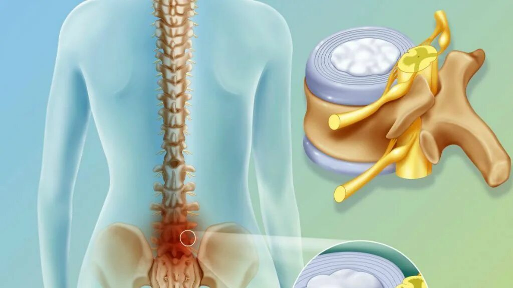 Межпозвонковая грыжа без операции. Грыжа позвоночника. Межпозвонковая грыжа симптомы. Межпозвоночная грыжа грыжа поясничного отдела. Грыжи дисков поясничного отдела позвоночника.