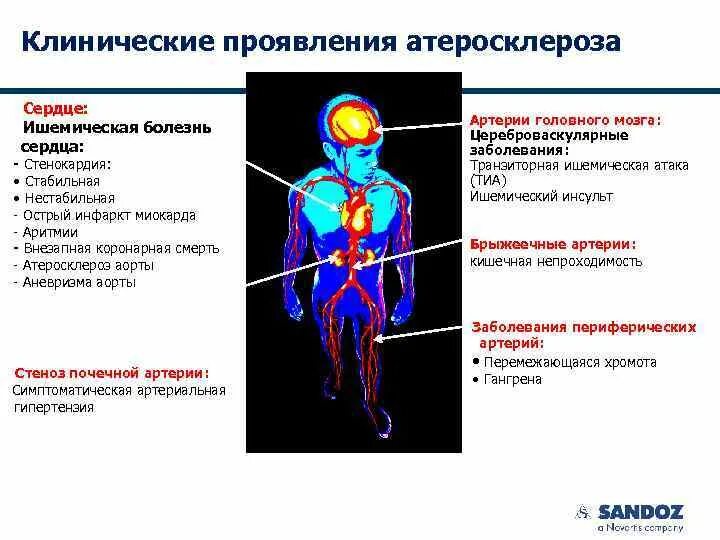 Атеросклеротическая болезнь сердца. Атеросклеротическая болезнь сердца