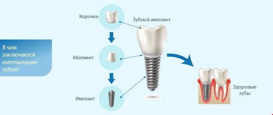 Сколько времени занимает установка импланта. Составные части импланта зуба. структура импланта зуба. имплантация зубов схема установки.