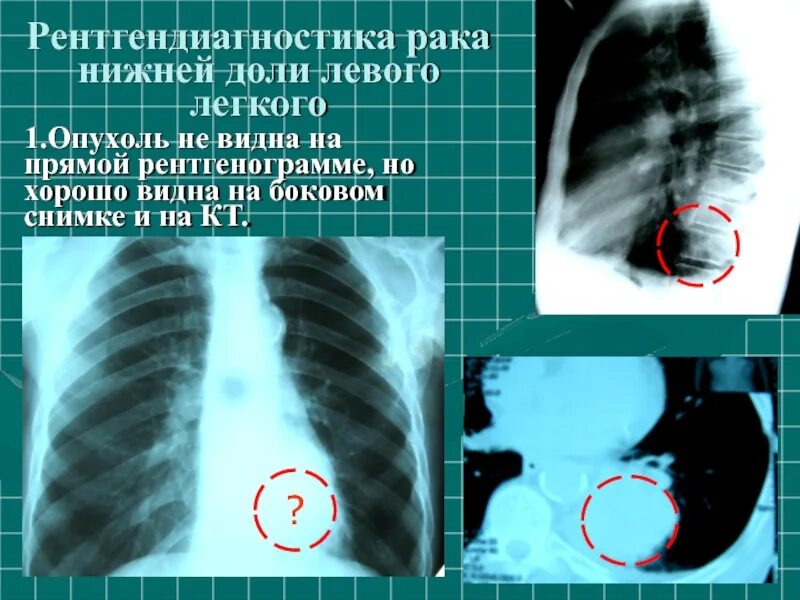 Рак легких 1