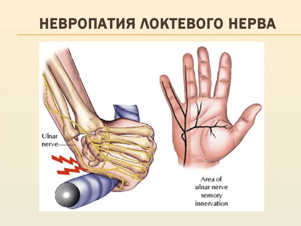 Поражение нервов руки. Неврит (невропатия) локтевого нерва.. Невропатия локтевого нерва симптомы. Нейропатия локтевого и лучевого нерва. Нейропатия локтевого нерва синдром.