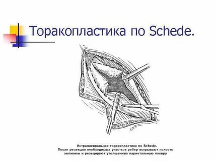Торакопластика