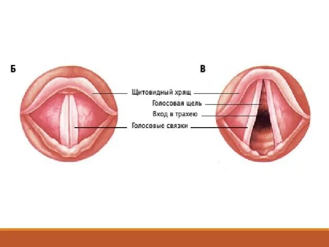 Голосовые связки при разговоре. Голосовые связки и голосовая щель. Ларингит голосовые складки. Полип голосовой складки. Голосовая щель гортани.