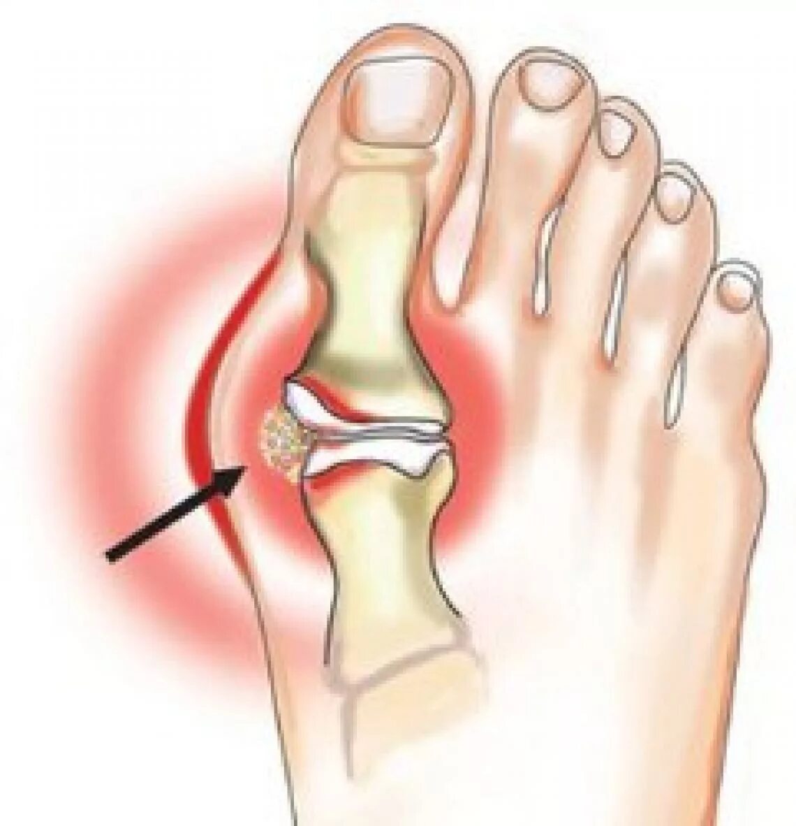 Подагра воспаление суставов. Подагрический артрит большого пальца ноги.