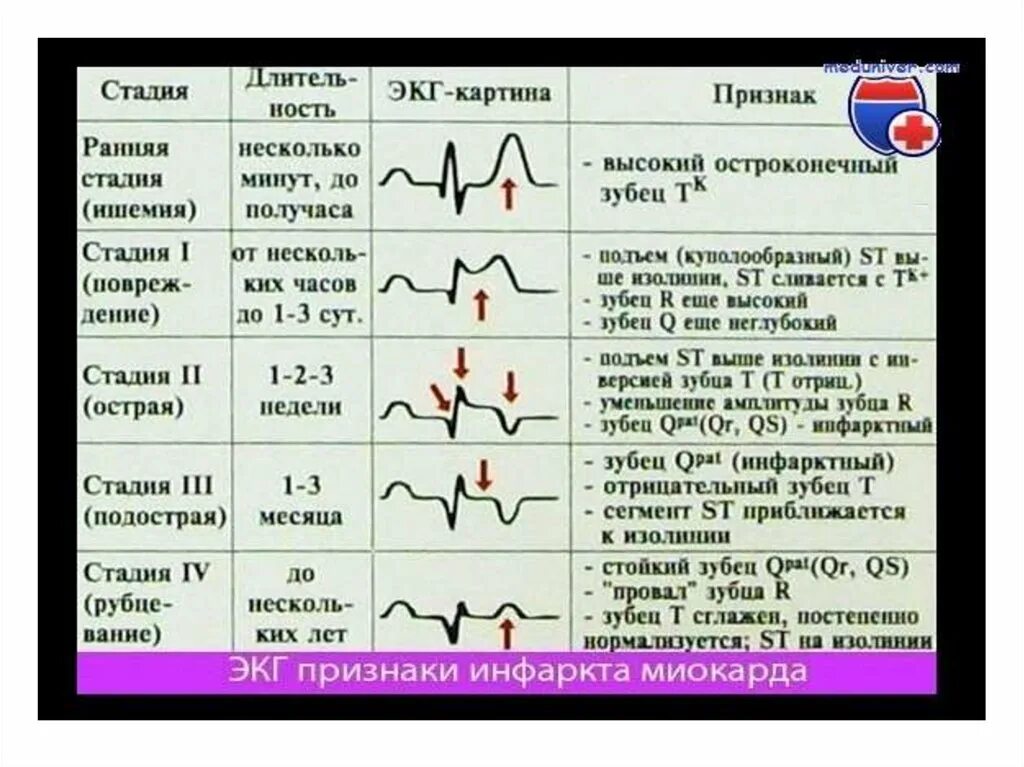 Изменение зубца q. Зубец т на ЭКГ при инфаркте миокарда. ЭКГ высокий зубец т v2-v4. Инфаркт миокарда зубцы на ЭКГ. Стадии развития инфаркта миокарда на ЭКГ.