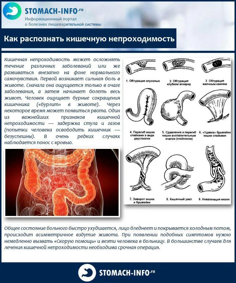 Колики в животе лекарства. Спастическое сокращение кишечника. Заболевания вызывающие кишечную непроходимость. Кишечная непроходимость симптомы и синдромы. ГАЗЫ при кишечной непроходимости.