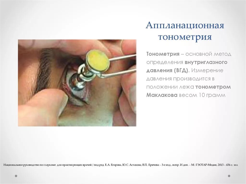 Аппланационная тонометрия Маклакова. Тонометрия (измерение глазного давления). Тонометр аппланационный Маклакова. Метод измерения внутриглазного давления по маклакову.