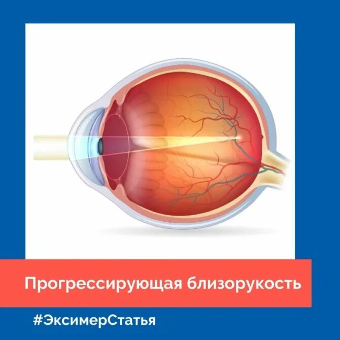 Прогрессирование миопии