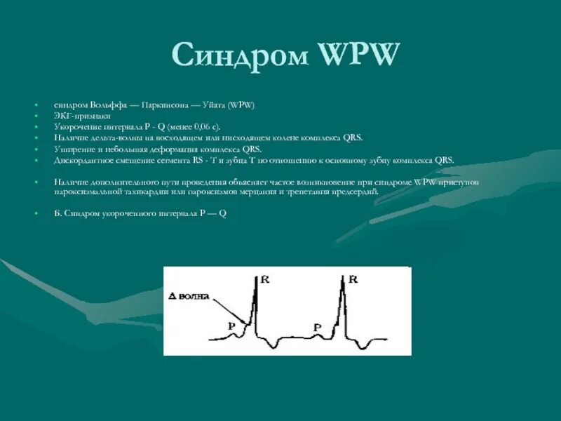 Синдром вольфа уайта. Экг критерии синдрома wpw. экг при синдроме вольфа паркинсона уайта. критерии впв синдрома на экг. при синдроме вольф-паркинсон-уайта (wpw) на экг наблюдаются.