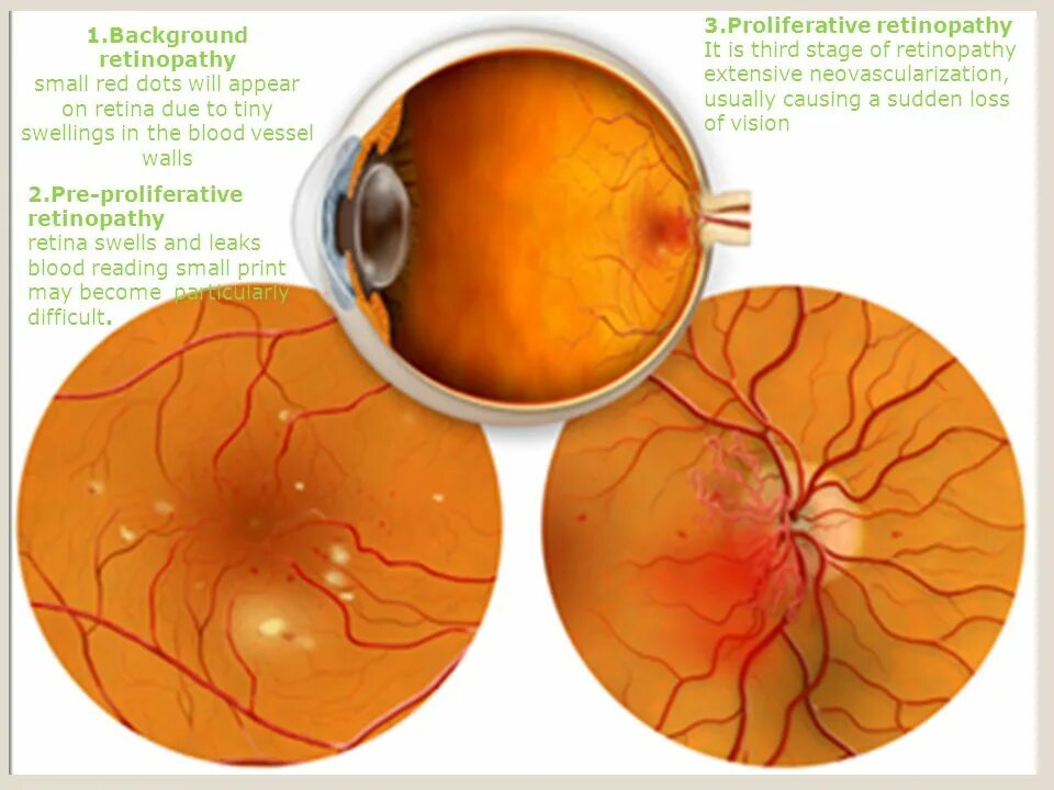 Псориатическая ретинопатия. Диабетическая ретинопатия сетчатки. Атеросклеротическая ретинопатия. Пролиферативная диабетическая ретинопатия макулярный отек.