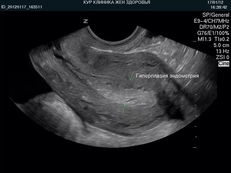 Эндометрия матки УЗИ гиперплазия эндометрия. Гиперпластические процессы эндометрия УЗИ. Гиперплазия эндометрия УЗИ картина. Гипоплазия эндометрия на УЗИ. На узи видно рак шейки