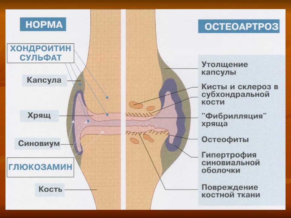 Деформирующий остеоартроз. Причины первичного остеоартроза. Остеоартроз с деформацией.
