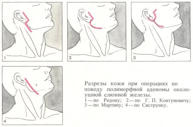 Субтотальная резекция околоушной железы. Резекция подчелюстной железы. Разрез по ковтуновичу железы. Операции на околоушной слюнной железе. Операции на околоушной слюнной железы.